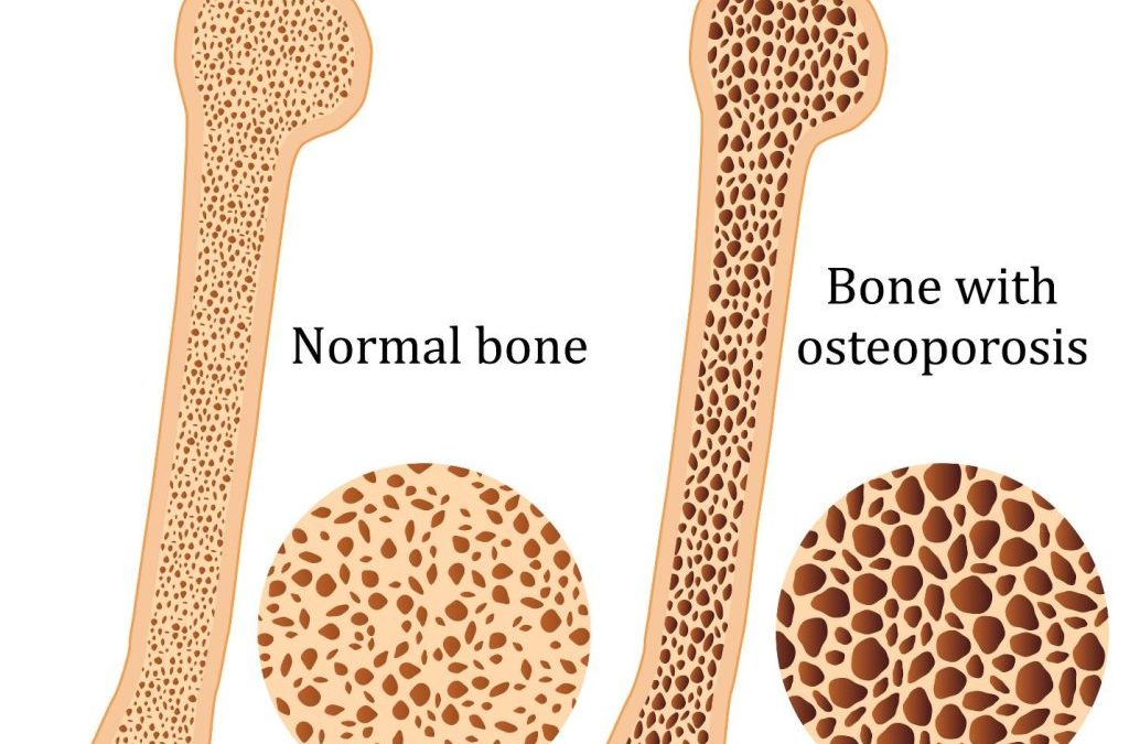 A Natural Approach to Osteoporosis and Bone Health