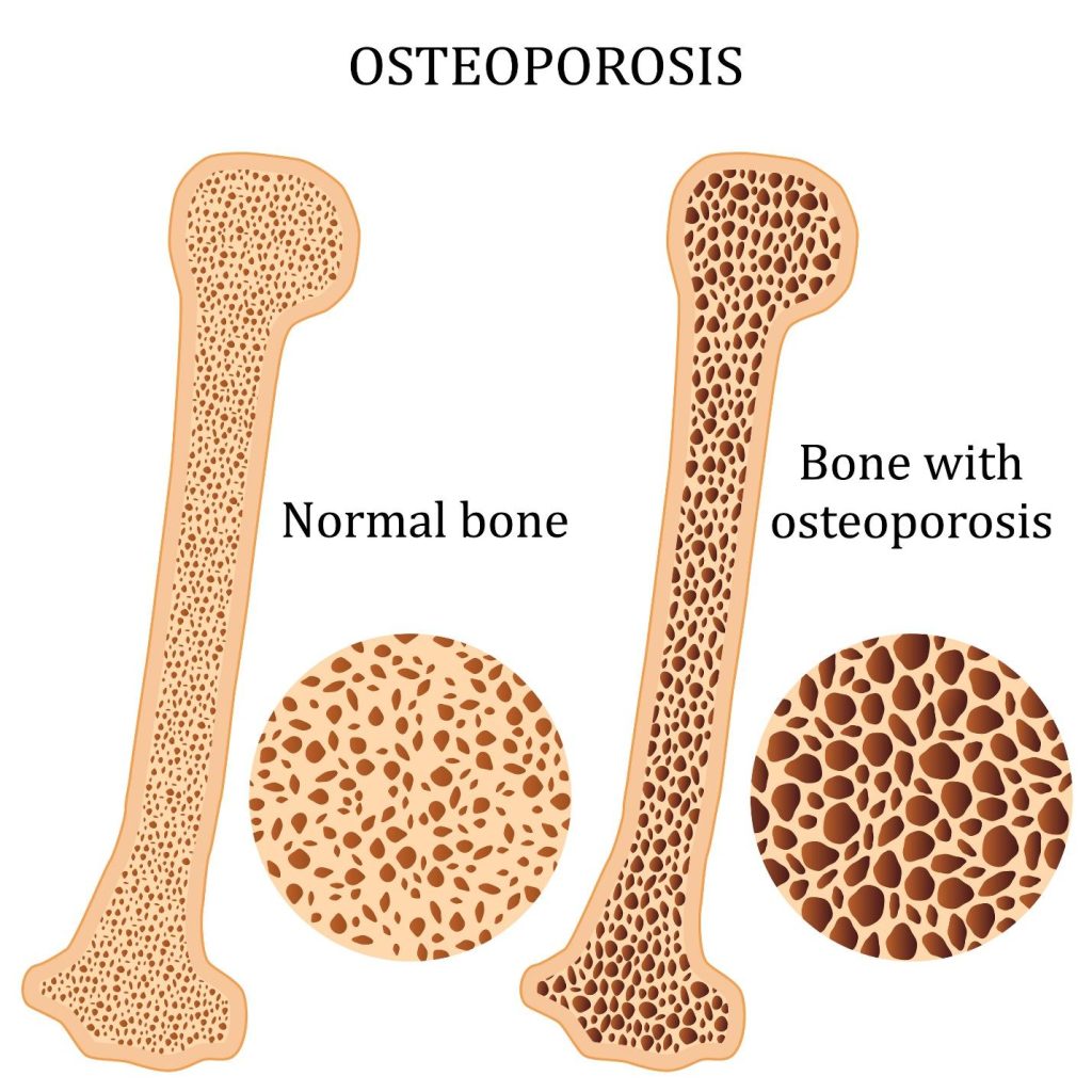 Bone Health